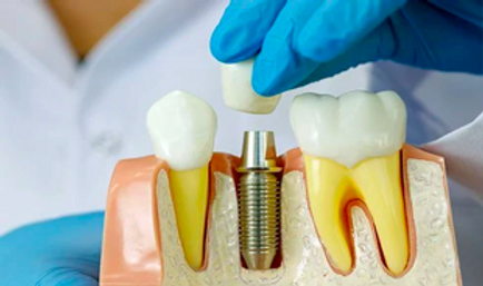 Major Points To Consider After An Implant Surgery