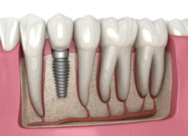 Post Dental Implant Care Instructions - Things to Consider After Implant Surgery