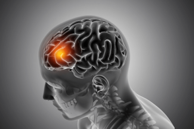 Concussion