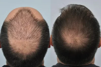hailfall comparison