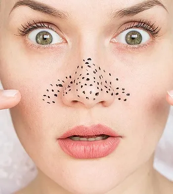 How to remove blackheads easily